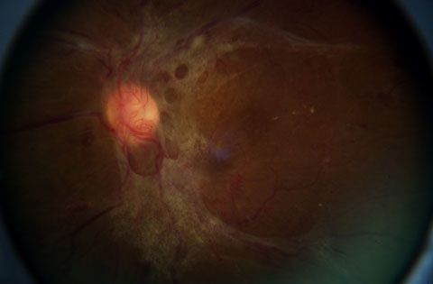 Diabetic Retinopathy